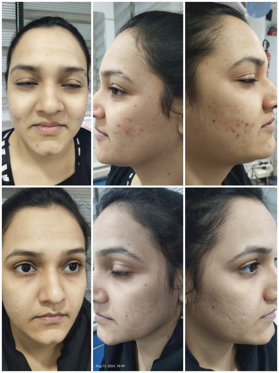 Chemical peeling results