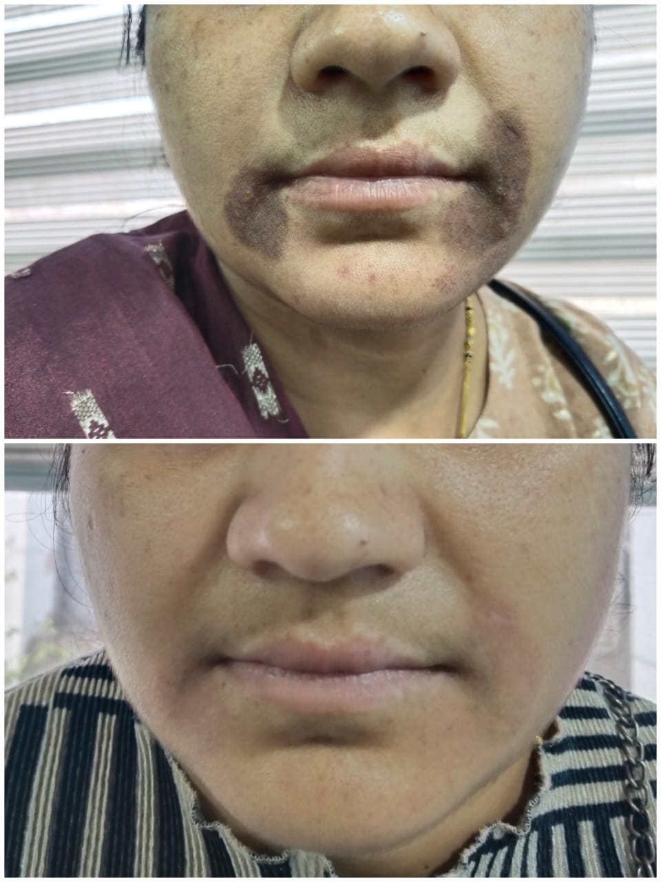 Chemical peeling results