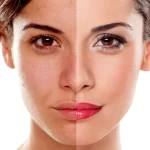 Best Skin Peeling Treatment Surat