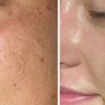 HydraFacial for Smooth Skin