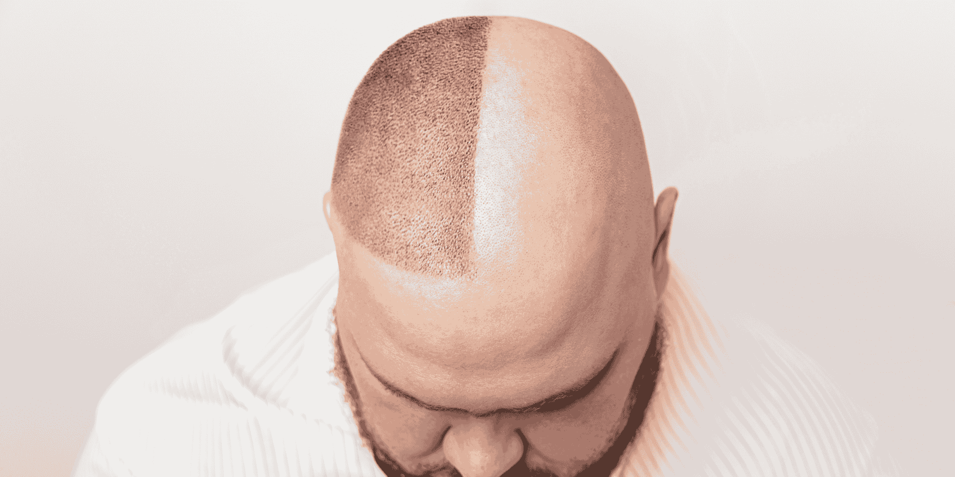 permanent hair transplant in Surat
